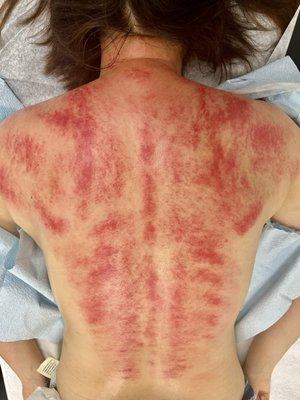 刮痧 Gua Sha