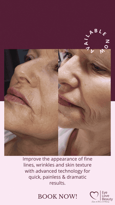 RF Micro-Needling now available