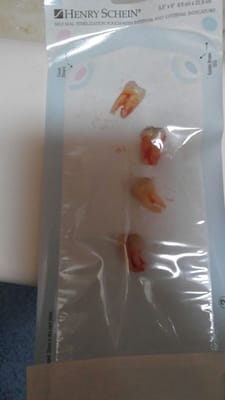 My wisdom teeth