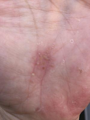 close up of left hand postules ceacked skin hardens peels repeat