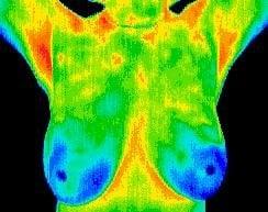 Thermal Breast Image