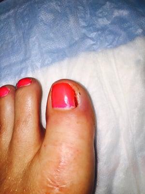 1 week after pedicure. Still infected