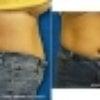 Laser liposuction - Before and After pictures