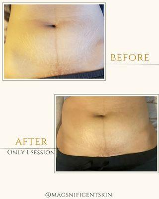 Stretch Mark Rejuvenation treatment on abdomen, before and after only one session.