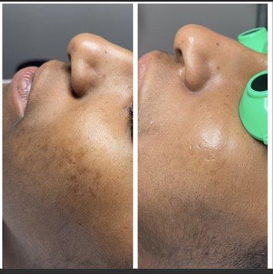 Treating hyperpigmentation.