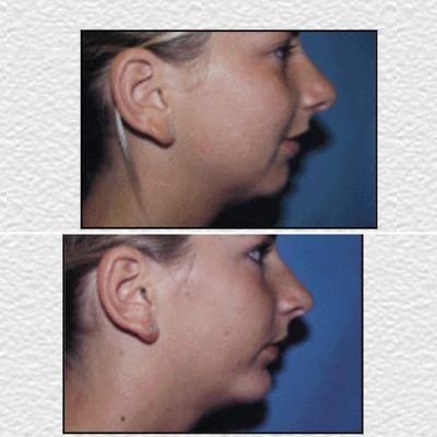 Chin Definition with a chin implant