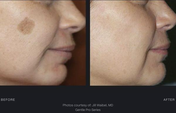 Benign Pigment Removal B&A