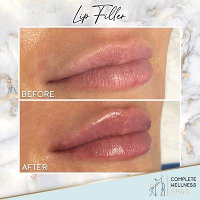 Lip Filler is our love-Baby lips available and more