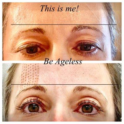 Plasma Pen eyebrow lift