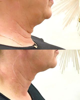 Thread Lift for Neck and Jawline