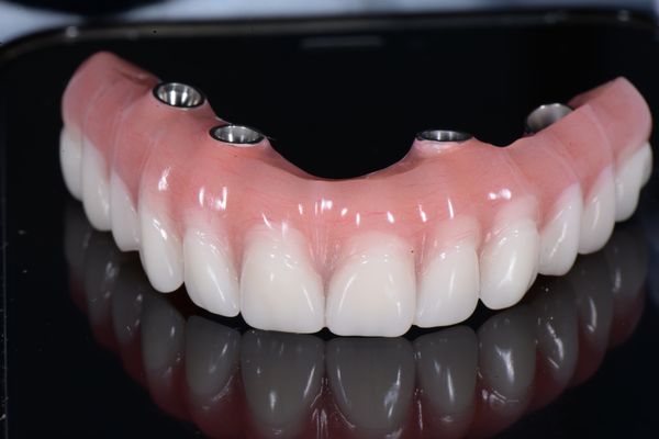 Implant supported teeth