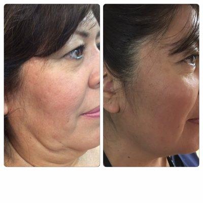 Before and After Pictures of 1 treatment of Kybella using 4 vials. Amazing results!