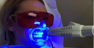 State of the art laser teeth whitening - Studio Smile San Diego