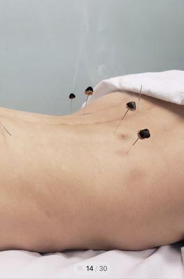 Dohee acupuncture