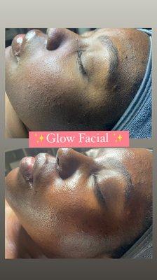 Glow facial