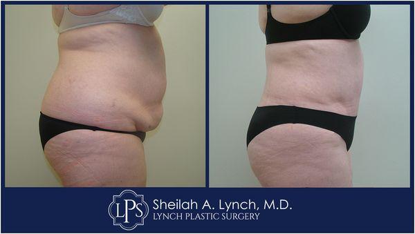 Lipo 360 Before & After Patient Receive an expert opinion from Board Certified Plastic Surgeon  Dr. Sheilah A. Lynch.