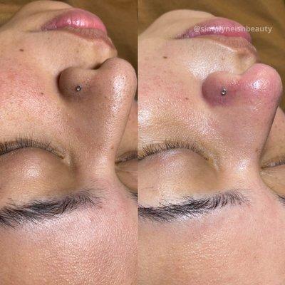 Blackhead Extractions