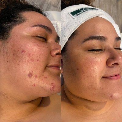 Dmk enzyme treatment works wonders on any type of acne!