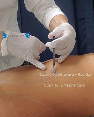 MESOTERAPIA ABS