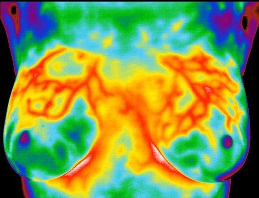 Breast thermography