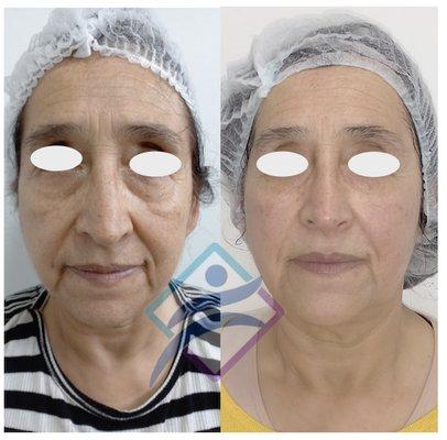 Skin Rejuvenation.  Wrinkle Reduction.
Rejuvenecimiento facial
Reducción de arrugas