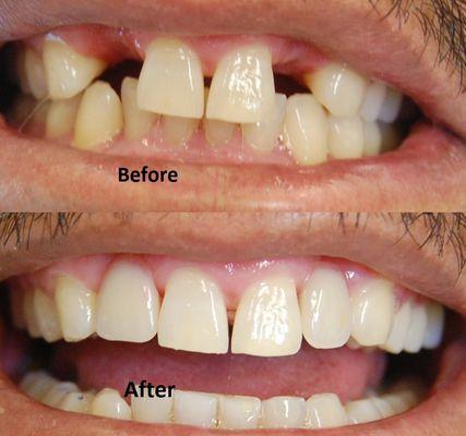 Restoration of missing teeth with Partial Denture at North Bay Dental San Rafael.