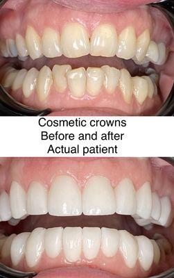 Cosmetic crowns. Before and After photos of actual patient. Encino Aesthetic Dental Group