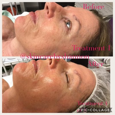 Get your skin on track with regular facials.. the proof is in the photos!