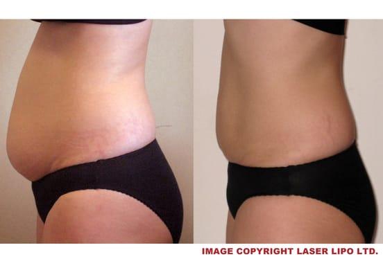 Before and after using Strawberry Laser Lipo 8 visits