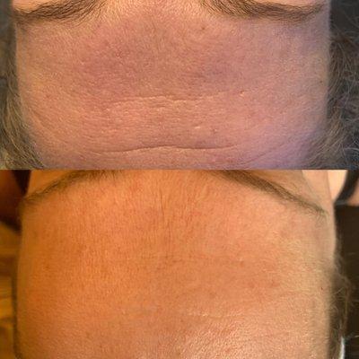 Before and after only TWO sessions of our microcurrent facial! Electric energy is used to tighten and tone the facial muscles.