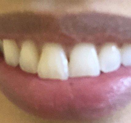 Seamless!! You can't even tell I have a filling in between my two front teeth! I'm very happy with the outcome of my fillings (:!