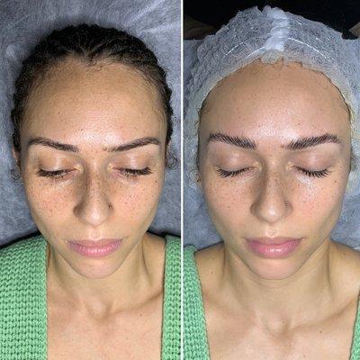 Before & After

Botnia Dermaplaning Skin Treatment +Oxygen Infusion and Brow Lamination + Lash Lift