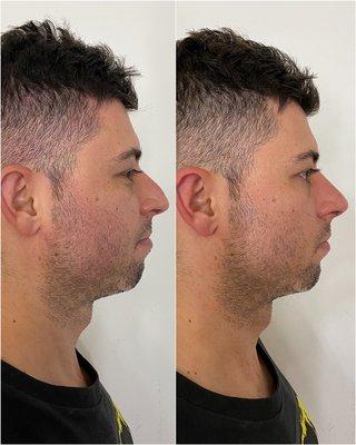 Non-surgical rhinoplasty (liquid nose job)