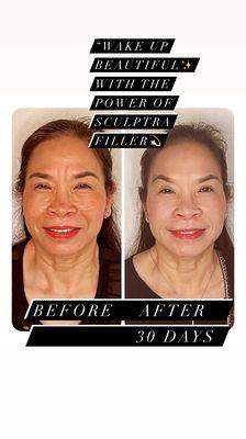 Collagen injectable booster Sculptra Before and After "Wake Up Beautiful" $7.99 for Botox, 10% off Filler/Collagen Booster