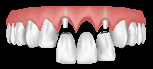 Dental Implant Bridge