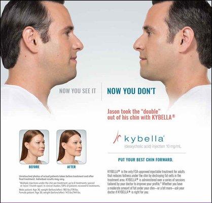 KYBELLA® is the only FDA-approved injectable treatment that destroys fat cells under the chin to improve your profile.