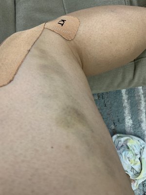 Bruise caused by "Dr." Samir Zaqdan