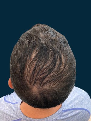 PRP Hair Restoration After