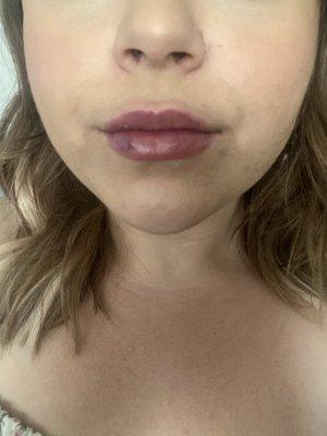 After one syringe juvederm plus