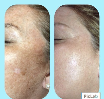 Photo facial, after 3 treatments with no downtime. #ESAB #ipl #beauty #Best