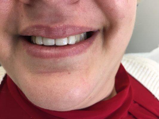 Veneers after