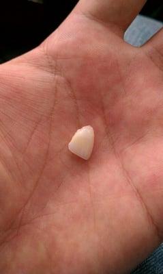 My tooth that Dr. Thibauit put back on like a veneer