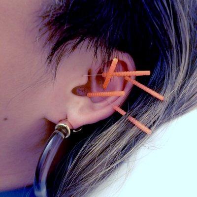 Ear acupuncture treatment to support quitting smoking