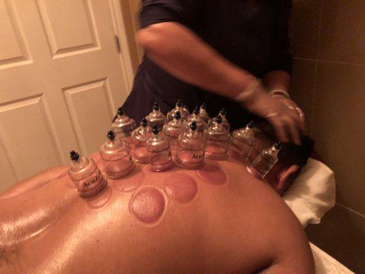 Cupping therapy