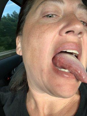 Cancer on tongue