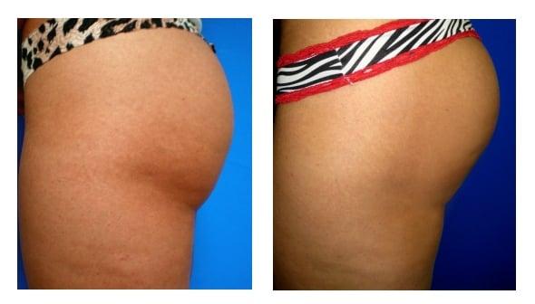 Before and after P-FAB (butt augmentation).