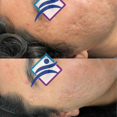 Acne Scar Reduction
Reducción de Cicatriz de Acne