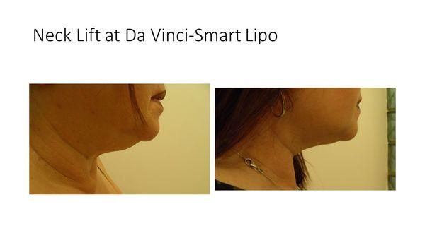 Smart Lipo Neck Lift