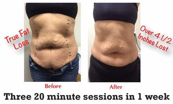 The Strawberry Lipo Laser is the most effective body laser on the market