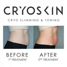 Cryoskin Slimming and Toning